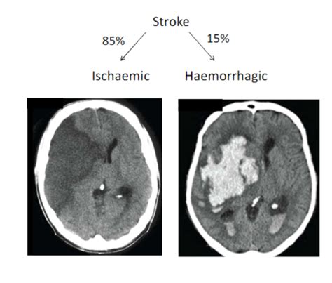 Cerebrovascular Disease Flashcards Quizlet