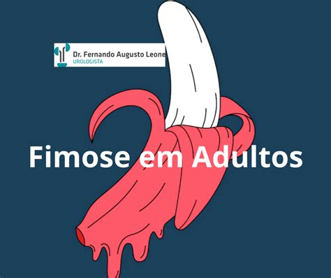 Fimose Em Adultos Dr Fernando Leone Urologista Bh Uro Bh