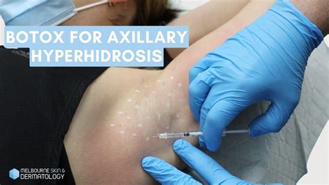 Botox For Axillary Hyperhidrosis Melbourne Skin Dermatology Youtube