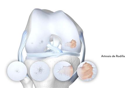 Plasma Rico En Plaquetas Para Artrosis De Rodilla Tmr Buenos Aires