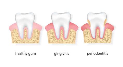 Perio Protect To Whiten Teeth And Fight Gum Disease Radiance Dental