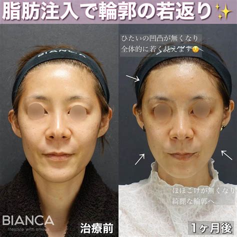 辻沢由有（bianca Clnic 表参道院 院長）さんのインスタグラム写真 辻沢由有（bianca Clnic 表参道院 院長）instagram 「【脂肪注入でアンチエイジング