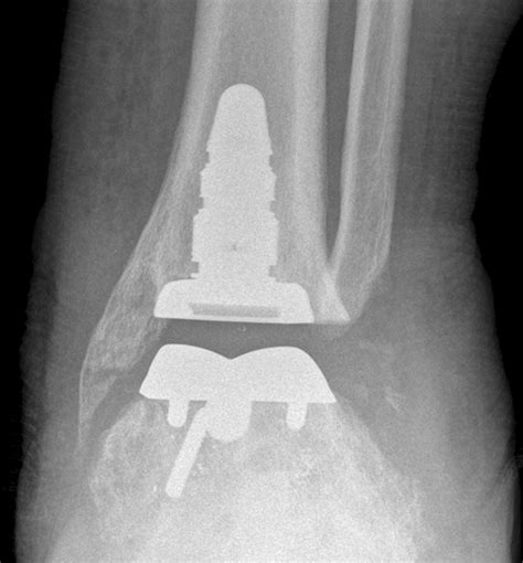 Current Concepts In Total Ankle Replacement For Radiologists