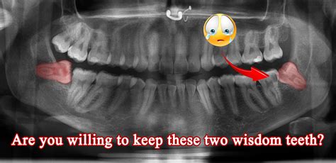 Normal Wisdom Teeth X Ray