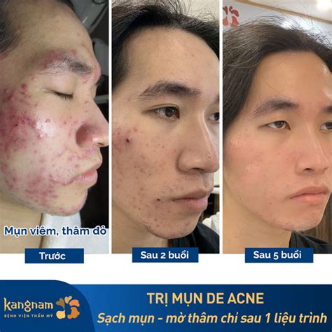 Mụn Bọc ở Cổ Tìm Hiểu Nguyên Nhân Giai đoạn Phát Triển Và Cách điều