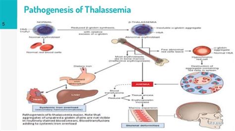 Thalassemia