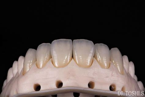 Facial Cutback Zirconia 6 11 With Printed Model Dentaltechnician