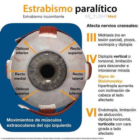 Estrabismo Paralítico Anatomia y fisiologia humana Optica y