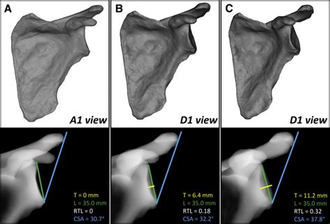 Editorial Commentary Is Your Critical Shoulder Angle Accurate Only If