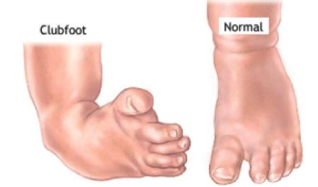 Club Foot Disorders — Davis Shoe Therapeutics