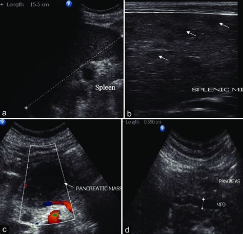 A Splenomegaly B Multiple Ill Defined Focal Hypoechoic Arrow