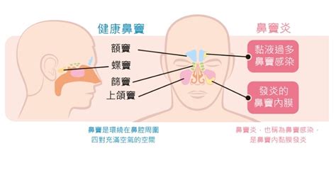 如何區分鼻竇炎、感冒、鼻過敏？鼻息肉「春風吹又生」怎麼辦？ 康健雜誌