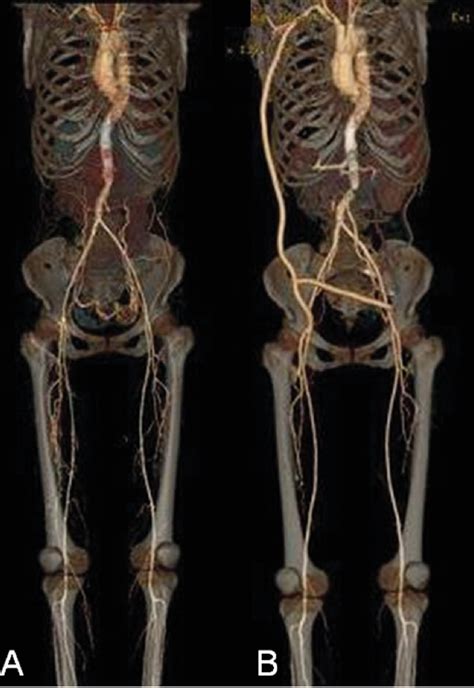 Figure 2 From Axillobifemoral Bypass For Aortitis Syndrome In A Living Donor Liver Transplant