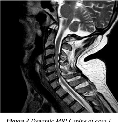 Figure 4 From Dynamic Mri Of The Cervical Spine An Important Tool In