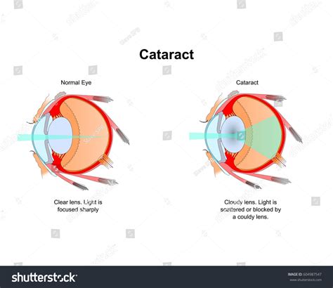 1,659 Cataract eye anatomy Images, Stock Photos & Vectors | Shutterstock