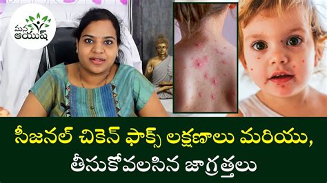 Chicken Pox Causes | Symptoms | infection prevention | How to Treat Chicken Pox | Mana Ayush ...