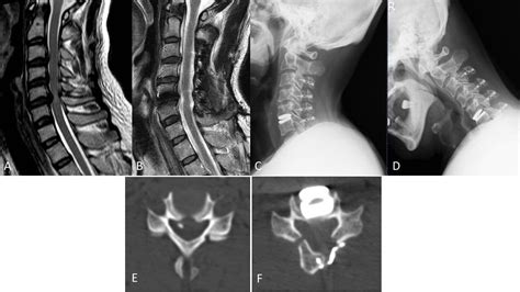 Combining Laminoplasty With Artificial Disc Replacement For The