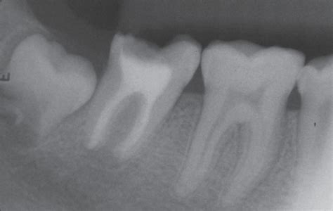 Conservative Non Surgical Management Of An Infected Radicular Cyst Pmc