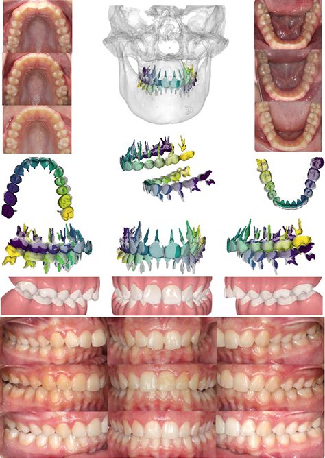 Clear Aligner Mandibular Advancement In Growing Patients With Class Ii Malocclusion Ajo Do