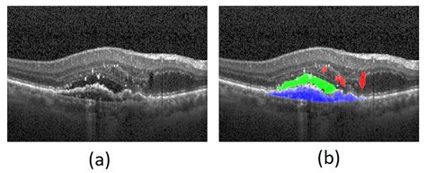 Wet Macular Degeneration Oct