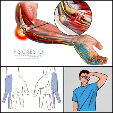 Exclusión falta base dolor cubital muñeca tratamiento paso Peatonal