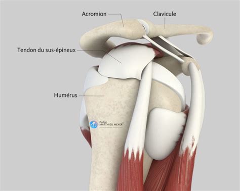 Acromioplastie de lépaule par arthroscopie Docteur Matthieu Meyer