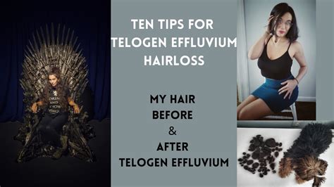 Ten Tips For Telogen Effluvium Hairloss Before And After Hairloss Youtube