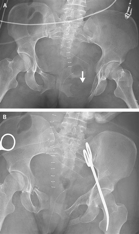 Pelvic Fracture X Ray