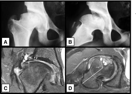 Figure From Mri Abnormalities Of The Acetabular Labrum And Articular