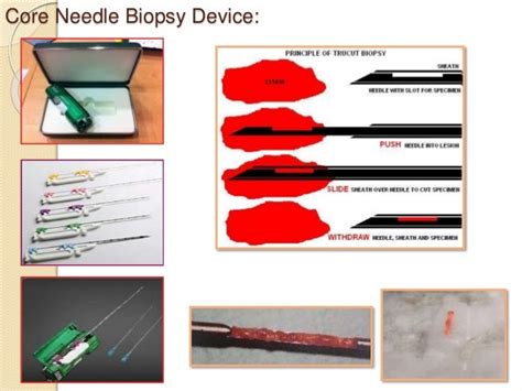 Core Needle Biopsy of Breast : Updates