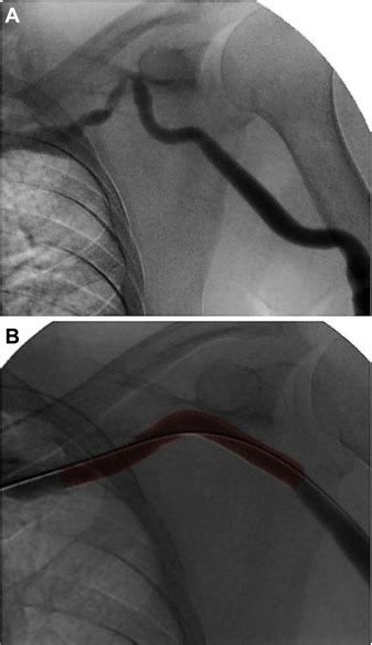 Use Of The Viabahn Stent Graft For The Treatment Of Recurrent Cephalic