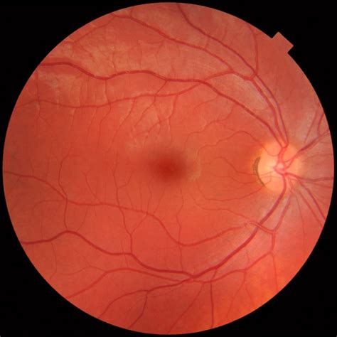 Fundus_photograph_of_normal_right_eye - Doris Lu, Optometrist