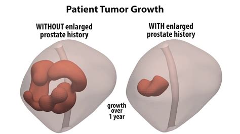 Enlarged Prostate Cancer