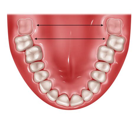 What Age Does Wisdom Teeth Come In Boston Dentist Congress Dental Group 160 Federal St Floor