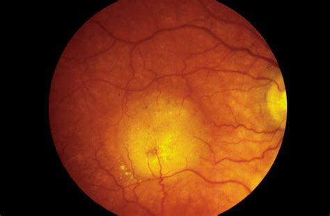 Retinal Angiomatous Proliferation Dermatology Jama Ophthalmology