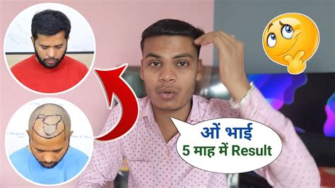 Hair Transplant 5 Months Result Hair Transplant In Bhopal QHT Taknik