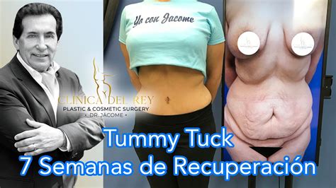 7 Semanas de Recuperación de Tummy Tuck en Clínica del Rey del Dr