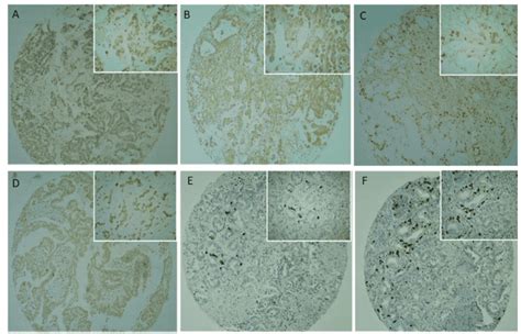 Cancer Stem Cells Markers Associated With Development And Aggressive