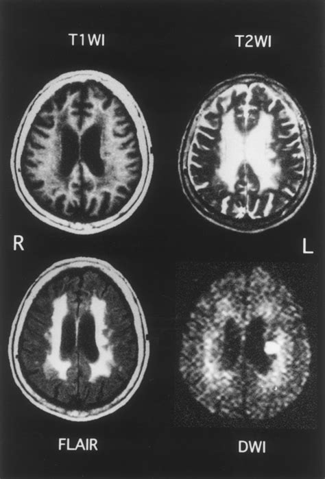 Diffusion Weighted Mri In Severe Leukoaraiosis Stroke