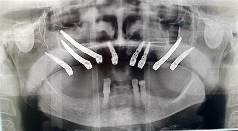 Guided Zygomatic And Pterygoid Implants Using Ezgoma Noris Medical