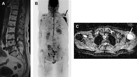 Whole Body Imaging In Multiple Myeloma Magnetic Resonance Imaging Clinics