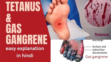 Surgery Lecture -Tetanus, Gas Gangrene easy hindi explanation. #tetanus ...