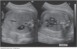 Ch Fetal Echocardiography Flashcards Quizlet