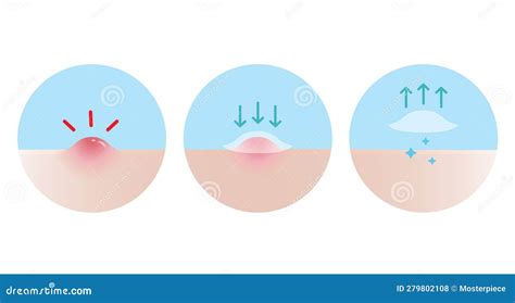 Acne Pimple Treatment For Pustule Vector Illustration On Sky Blue