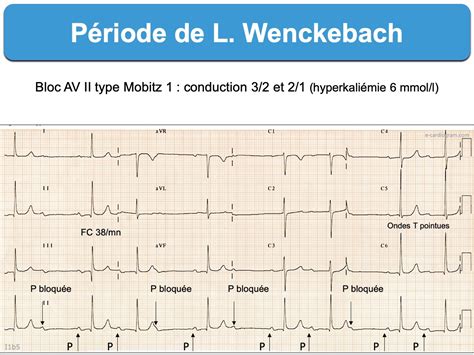 Période De Luciani Wenckebach E Cardiogram