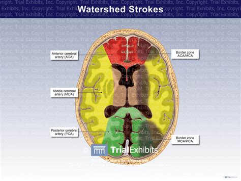 Watershed Strokes Trial Exhibits Inc