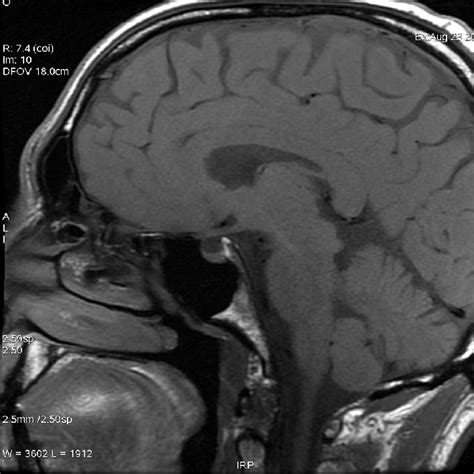 Sagittal T1 Weighted Mri Showing A Partial Empty Sella Syndrome Download Scientific Diagram