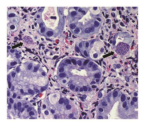 Gastric Biopsy Specimen Showing Large Cystic Forms Present In The Download Scientific Diagram