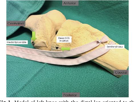 Figure 1 From Modified Bosworth Technique For Medial Collateral Ligament Reconstruction Of The