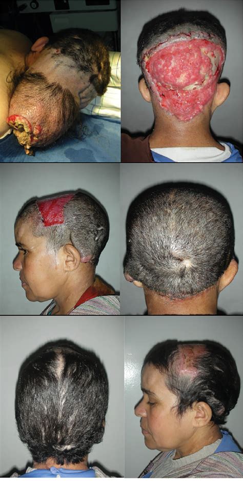 [pdf] Unusual Evolution Of Plexiform Neurofibroma In The Scalp A Case Report Semantic Scholar